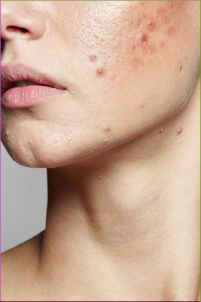 breakouts